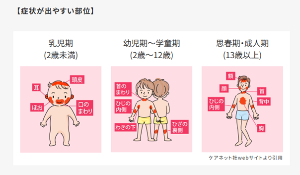 アトピー性皮膚炎について | 桜新町皮フ科クリニック