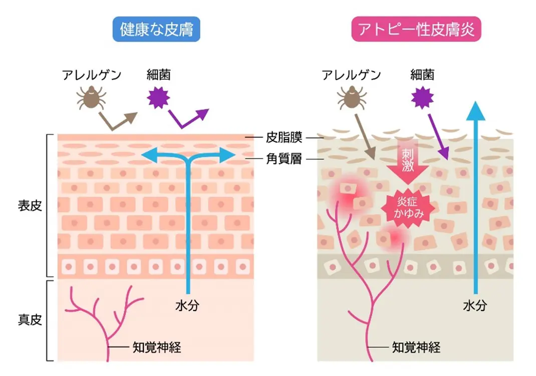 皮脂 汗 人気 石鹸 アトピー