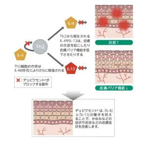 ④アトピー性皮膚炎の治療～注射編～ | 桜新町皮フ科クリニック